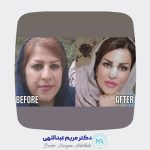 جراحی زیبایی بینی
